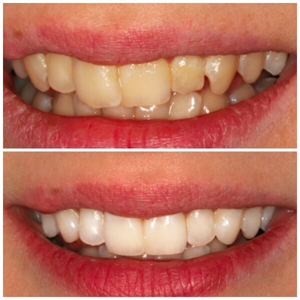 Przed i po zabiegu stomatologii estetycznej